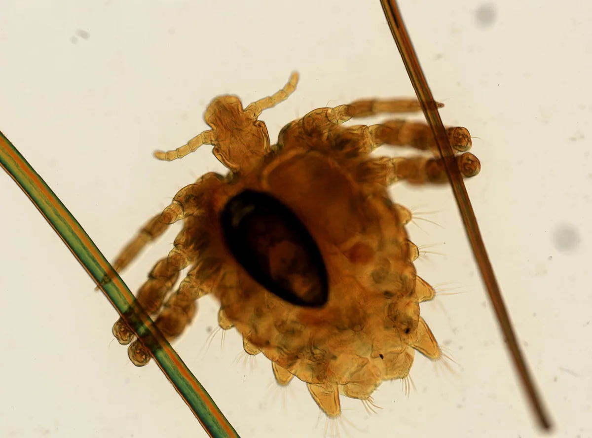 Crab louse under magnification, a small brown louse with crab-like claws gripping a hair